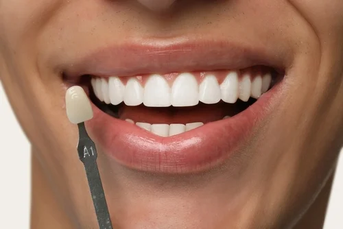Porcelain veneers